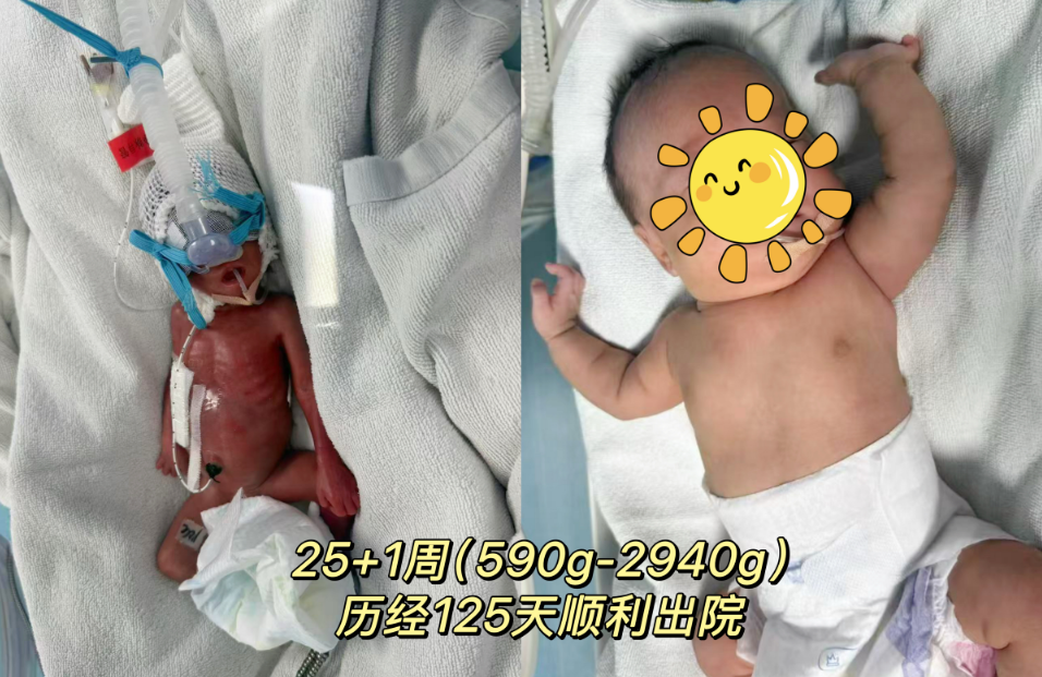 生命奇跡再刷新！懷化市婦幼保健院成功救治 25 周 出生體重僅590g的“掌心寶寶”